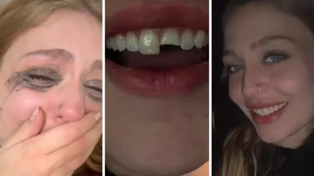 Jovem quebra dente na balada no PR, cola na madrugada e volta para a festa jovem-quebra-dente-na-balada-no-pr,-cola-na-madrugada-e-volta-para-a-festa