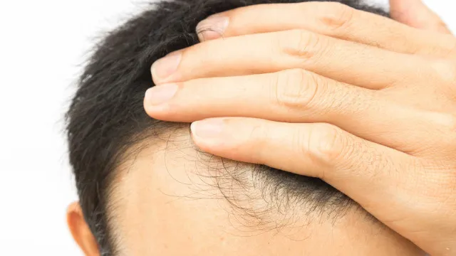 Cabelo transplantado pode cair? Veja alguns detalhes sobre o procedimento cabelo-transplantado-pode-cair?-veja-alguns-detalhes-sobre-o-procedimento